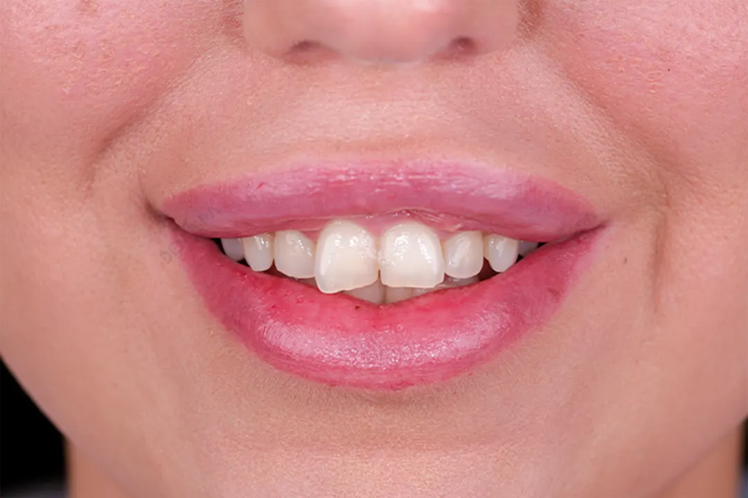 Before Image