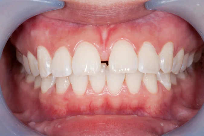 Tooth Gap (Diastema): Causes, Options and How to Kapat It